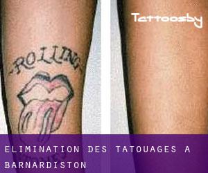Élimination des tatouages à Barnardiston