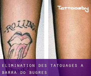 Élimination des tatouages à Barra do Bugres