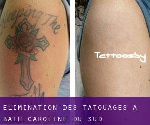 Élimination des tatouages à Bath (Caroline du Sud)