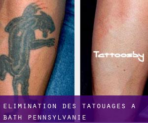 Élimination des tatouages à Bath (Pennsylvanie)