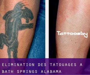 Élimination des tatouages à Bath Springs (Alabama)