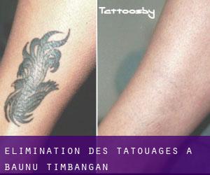 Élimination des tatouages à Baunu-Timbangan