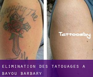 Élimination des tatouages à Bayou Barbary