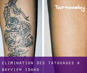 Élimination des tatouages à Bayview (Idaho)