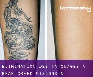 Élimination des tatouages à Bear Creek (Wisconsin)