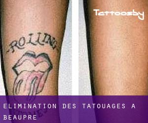 Élimination des tatouages à Beaupré