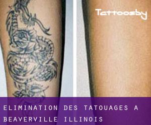 Élimination des tatouages à Beaverville (Illinois)