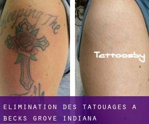 Élimination des tatouages à Becks Grove (Indiana)