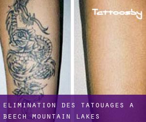 Élimination des tatouages à Beech Mountain Lakes