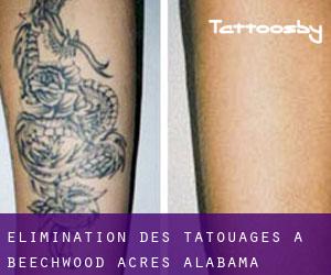 Élimination des tatouages à Beechwood Acres (Alabama)