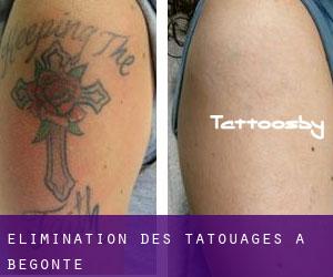 Élimination des tatouages à Begonte