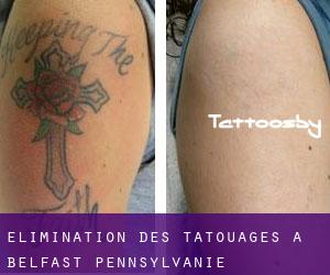 Élimination des tatouages à Belfast (Pennsylvanie)