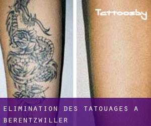 Élimination des tatouages à Berentzwiller