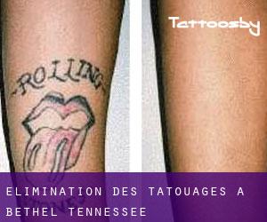 Élimination des tatouages à Bethel (Tennessee)