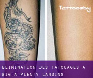 Élimination des tatouages à Big A Plenty Landing