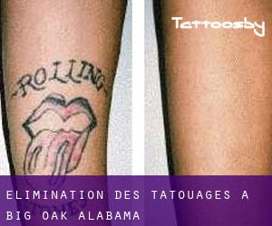Élimination des tatouages à Big Oak (Alabama)