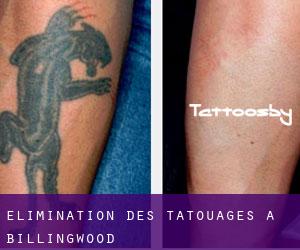 Élimination des tatouages à Billingwood