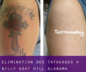 Élimination des tatouages à Billy Goat Hill (Alabama)