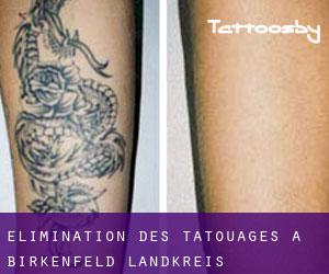 Élimination des tatouages à Birkenfeld Landkreis