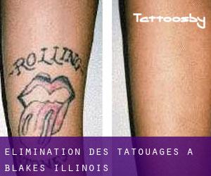 Élimination des tatouages à Blakes (Illinois)