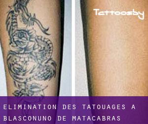 Élimination des tatouages à Blasconuño de Matacabras