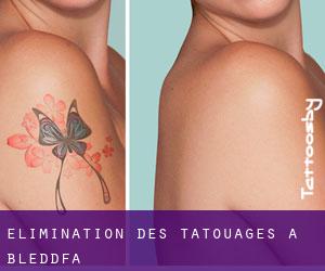 Élimination des tatouages à Bleddfa