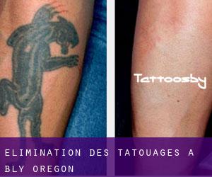 Élimination des tatouages à Bly (Oregon)