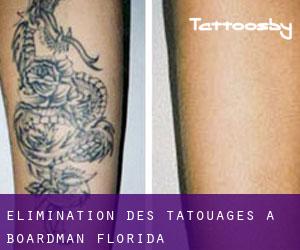 Élimination des tatouages à Boardman (Florida)