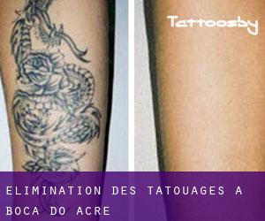 Élimination des tatouages à Boca do Acre