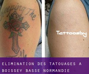 Élimination des tatouages à Boissey (Basse-Normandie)