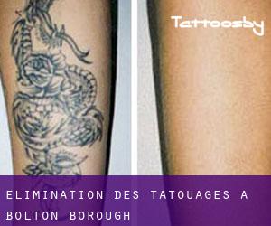 Élimination des tatouages à Bolton (Borough)