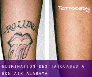 Élimination des tatouages à Bon-Air (Alabama)