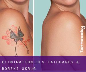 Élimination des tatouages à Borski Okrug