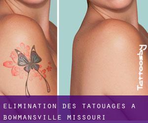 Élimination des tatouages à Bowmansville (Missouri)