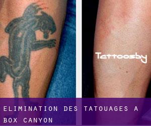 Élimination des tatouages à Box Canyon