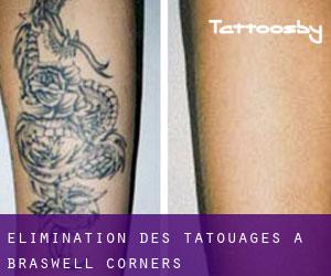Élimination des tatouages à Braswell Corners