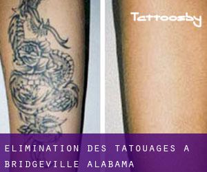 Élimination des tatouages à Bridgeville (Alabama)