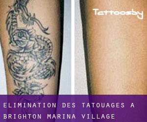 Élimination des tatouages à Brighton Marina village