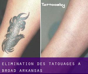 Élimination des tatouages à Broad (Arkansas)