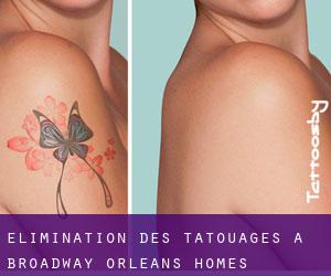 Élimination des tatouages à Broadway-Orleans Homes