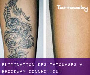 Élimination des tatouages à Brockway (Connecticut)