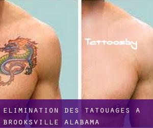 Élimination des tatouages à Brooksville (Alabama)