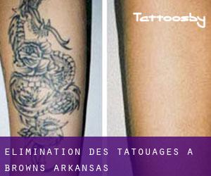 Élimination des tatouages à Browns (Arkansas)