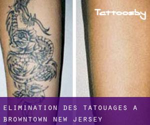 Élimination des tatouages à Browntown (New Jersey)