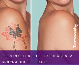 Élimination des tatouages à Brownwood (Illinois)