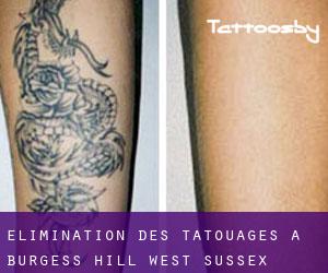 Élimination des tatouages à burgess hill, west sussex