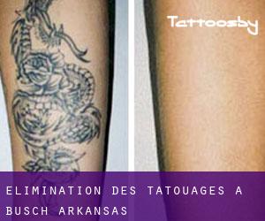 Élimination des tatouages à Busch (Arkansas)