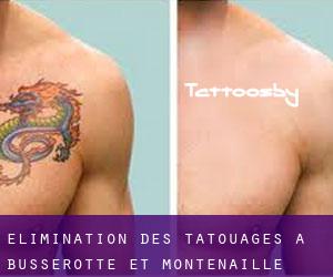 Élimination des tatouages à Busserotte-et-Montenaille