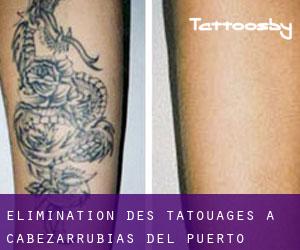 Élimination des tatouages à Cabezarrubias del Puerto