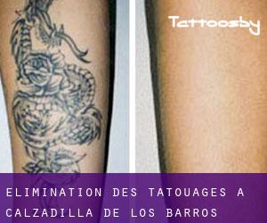 Élimination des tatouages à Calzadilla de los Barros
